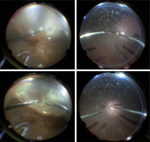 Figure 3 Fundus view of the wide-angle viewing system with a 128-diopter objective lens alone (top), and use of the contact lens with the wide-angle viewing system (bottom) for removal of proliferative membrane in a case of proliferative vitreoretinopathy (left) and for performing posterior vitreous separation in a case of vitreomacular traction (right).