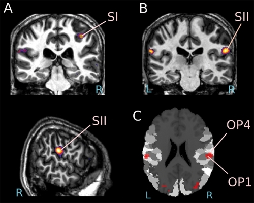 Figure 2. Activation of the primary and secondary somatosensory cortices in a single subject observing someone touching an object Functional images are superimposed on the subject's own anatomy (P<0.05 FDR corrected). (A) Coronal slice 33 mm posterior to the anterior commissure showing the activation of Brodmann area 2 of the primary somatosensory cortex (SI). (B) Coronal plane 26 mm posterior to the anterior commissure showing the activation of the secondary somato-sensory cortex (SII), and sagittal view of the right hemisphere at 60 mm from the midline showing the same cluster. (C) Overlay of SI activity on an anatomical probability map showing the location of OP1 and OP2 (SPM Anatomy Toolbox)