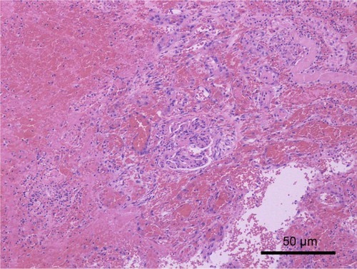 Figure 2 Pathologic findings of Case 1.