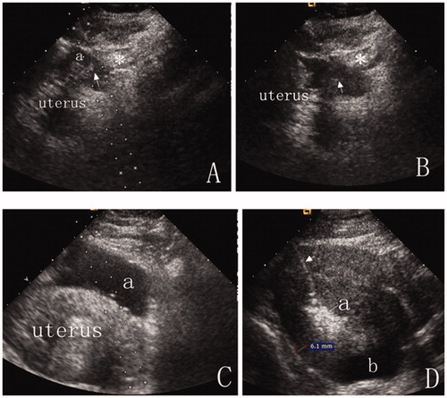 Figure 1. (A) An intravenous catheter (arrow) was inserted into the shallow site (a), and then, a small amount of saline was injected to separate the intestinal tract (*) from the uterus surface. (B) The catheter was inserted deeper, and the process (A) was repeated until the tip of the catheter (arrow) was positioned between the uterus and the bowel (*) under ultrasound guidance. (C) After anechoic artificial ascites was introduced, the gap between the uterus and abutting bowel (*) was widened. We then found a better antenna path. (D) Artificial ascites fluid was added into the pelvis, separating the uterus from adjoining structures by more than 5 mm. The separation was still identifiable after 15 min of ablation (Arrow = antenna, a = ablation zone, b = artificial ascites). Complete separation was achieved in this patient.