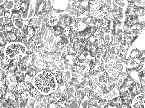 Figure 5. Kidney section of a glycerol+saline-treated rat (ARF group) showing severe tubular necrosis and cast formation (H&E, × 100).