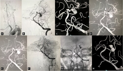 Figure 1. Embolization of irregular posterior cerebral artery aneurysms. (A) very tortuous supra-arch vessels. (B) left VA angiogram in working projection revealed highly irregular multi-lobulated left PCA aneurysm. (C) 3D reconstruction demonstrated the complex topography of the aneurysm. There were multiple aneurysms with different diameters located from the origin of the left PCA to the conjunction of P1 and P2. (D) the microcatheter tip could not be advanced further beyond the origin of the largest aneurysm neck (the black arrow) over the microwire because of the extremely high tension at the acute turning point of P1(the white arrow). We kept the microcatheter tip at the aneurysm neck and inserted the coil. Some of the loops entered the distal sac of the aneurysm. (E) with the coil being held stable, the microcatheter was advanced until its tip got into the distal sac of the aneurysm. (F) and (G) the aneurysms were completely occluded with the embolization. (H) Follow-up 3D reconstruction after seven months demonstrated ongoing occlusion of the aneurysm.