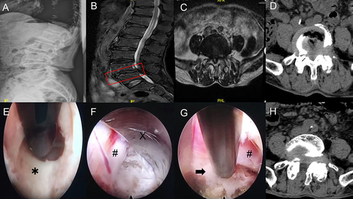 Figure 1 Pre-and postoperative imaging data of a patient in the interlaminar technique group. (A–D) The imaging data shows obvious stenosis of the L4-5 spinal canal. The red box in subfigure B indicates the site of lumbar stenosis. (E) Under endoscopic visualization, the ligamentum flavum is cut open. Asterisk shows the ligamentum flavum. (F and G) The working channel (X) is rotated, and the nerve root (#) is pushed gently away from the channel, then the herniated discs (black arrow) could be exposed for removal. (H) Postoperative cross-sectional CT shows a significant enlargement of the spinal canal.