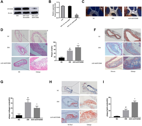 Figure 4 Effect of OUTD6B on atherosclerotic plaque formation and stability. (A) Western blot was used to detect OTUD6B expression in aorta tissue from each group. (B) The relative expression of the target protein was measured with the Image J software. (C) Representative images of aortic perfusion. (D) Representative images of H&E staining of aortic sections. (E) Quantification of plaque area. (F) Representative images of Masson staining of aortic sections. (G) Quantification of plaque collagen content. (H) Representative images of oil red O staining of aortic sections. (I) Quantification of plaque lipid content. #P<0.05 compared with the NC group. *P<0.05 compared with the DM group.