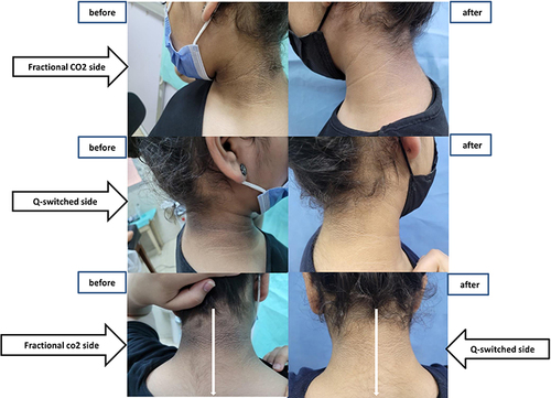 Figure 4 Patient 1 clinical photos before and after treatment.