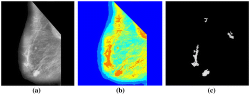 Figure 3. (a) Preprocessed image mdb005 with pectoral muscles removed (b) After applying multithresholding based on Otsu’s method and (c) Segmented ROIs.