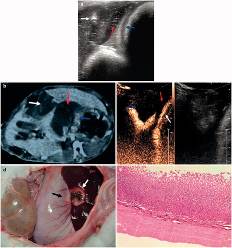 Figure 3. (a) Ultrasonographic view showing placement of the ablation needle (white arrow), with the in situ gel (red arrow) located between the liver and stomach wall (blue arrows). (b) Enhanced CT scan after ablation showing in situ gel (red arrow) between the lesion (white arrow) and the stomach wall (blue arrows). (c) Contrast-enhanced ultrasound CEUS, showing the gel (red arrow) located between the lesion (blue arrow) and the stomach wall (white arrow). (d) Photograph showing the microwave ablation area (white arrow) and the adjacent stomach wall (black arrow). (e) Histopathology, showing no stomach wall damage (H&E staining). For interpretation of the references to colour in this figure legend, please refer to the web version of this article at informahealthcare.com.