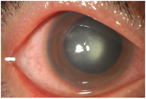 Figure 4 Ultimately, the continued progression of the inflammation led to ulceration in the center of the cornea.