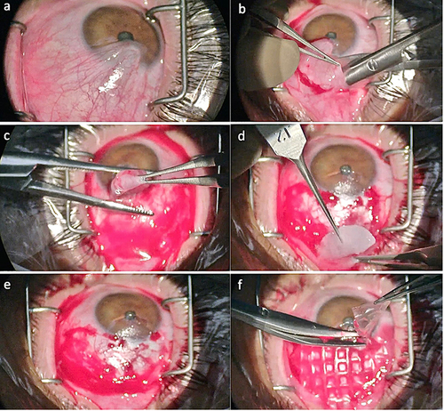 Figure 1 Surgical steps of TLDAM transplantation using the sutureless and glueless technique in pterygium surgery. (a) Before surgery (b) Separation of the PTG strand using blunt dissection (c) Resection of the PTG head (d) Subconjunctival application of MMC (e) Dried scleral bed (f) TLDAM shaped to size and tucked under the edges of the conjunctival defect.