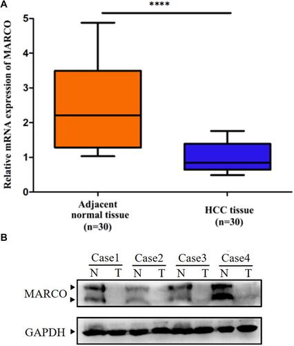 Figure 1 MARCO expression in paired HCC and matched nontumor tissues.