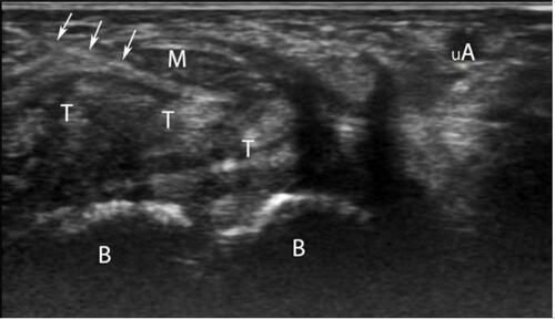 Figure 1 Ultrasound-guided CTS injection from radial side in transverse (short axis) view (M, median nerve; T, tendons; B, carpal bones; uA, ulnar artery; white arrows, needle).