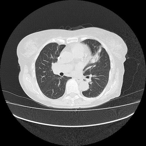 Figure 7 HRCT revealed eight neoplastic infiltrations in both lungs with the biggest one present in the middle field of the left lung with dimensions 17.7×26.0 mm.