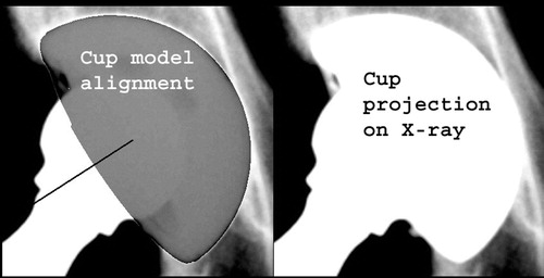 Figure 4. Computer screen view of the last step of the Xalign algorithm. A projection of the CAD model of the cup was overlaid on and matched with the actual X-ray cup projection to determine the cup abduction and version with respect to the anatomic reference system.