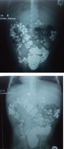 Figure 1 (A) Plain abdominal radiograph (erect view). (B) Plain abdominal radiograph (supine view).