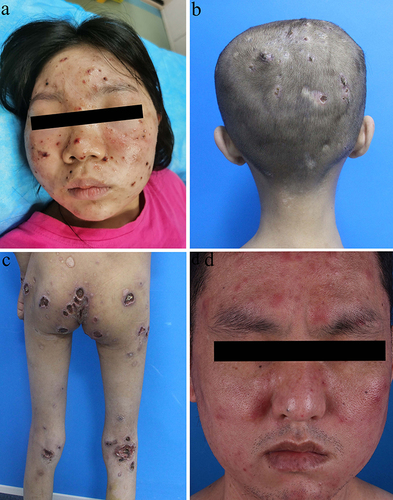 Figure 1 Clinical images of HVLPD patients. (a) Facial herpes burst and formed a scab. (b) The head formed multiple ulcers and scabs. (c) Multiple large and deep ulcers formed on the buttocks and lower limbs. (d) Typical facial swelling.