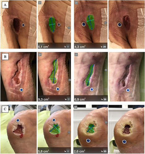 Figure 2 Example of planimetric effects of radial ESWT for a patient with a PU (A), VLU (B), and DFU (C).