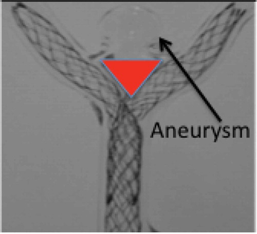 Figure 2. Illustration of dual Y-stenting in bifurcation aneurysm glass model, showing triangular gap between stents and neck of aneurysm.