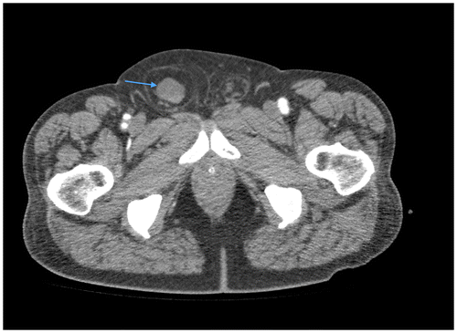 Figure 1b: Axial CT showing indirect inguinal hernia (blue arrow)