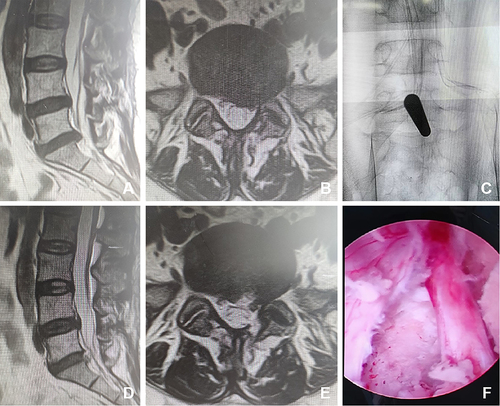 Figure 2 Female, 50 years old, L5/S1 lumbar disc herniation. (A) Preoperative sagittal MR image showed L5/S1 lumbar disc herniation; (B) Preoperative axial MR image showed herniated lumbar disc compressed nerve root and dural sac; (C) Intraoperative fluoroscopic confirmation of metal rods; (D) Postoperative sagittal MR image revealed the complete decompression of the spinal canal; (E) Postoperative axial MR image showed the complete removal of herniated disc and bony fragment; (F) Intraoperative image after complete neural decompression.