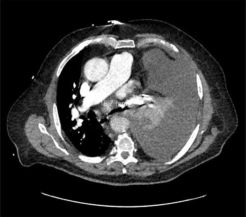 Figure 5 CT scan of December 28, 2020 representing a lymph node and pleural progression.