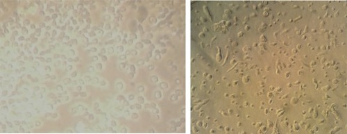 Figure 3 Control groups polyposis cell culture versus high dose of Avastin (250). The results showed a significant decrease of cell viability and deformation of nasal polyposis epithelial cells.