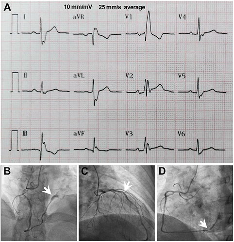 Figure 1 Visual Depictions of Cardiac Anomalies and Lesions. This figure presents a series of illustrations highlighting various cardiac anomalies and lesions identified in the patient. (A) An electrocardiogram showcasing a complete right bundle branch block, illustrating the electrical conduction abnormalities within the heart. (B) An anatomical illustration of the fistula forming a connection between the right coronary artery and the right atrium, as denoted by the white arrow, providing a visual understanding of the abnormal vascular communication. (C) Coronary angiography images displaying a diffuse-type lesion characterized by 50–60% stenosis within the mid-segment of the left anterior descending artery, with the area of stenosis indicated by the white arrow. (D) A depiction of significant 99% stenosis located in the proximal segment of the posterior branch of the left ventricle, positioned anterior to the fistula, as highlighted by the white arrow, underscoring the severity of the arterial narrowing.