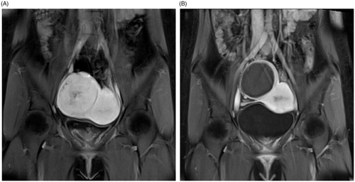 Figure 3. A 24-year-old woman with a right broad ligament uterine fibroid. The CE-MRI showed a right broad ligament uterine fibroid oppressing the right iliac vessels (A) and the non-perfused area of ablated fibroid (97.8% of NPV ratio) with intact serosal layer after HIFU ablation (B).