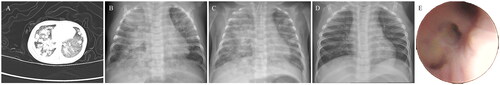 Figure 1. Radiographic findings. A. Thoracic CT at first admission revealed diffuse high-density nodular opacities of various sizes in both lungs. B. Chest radiograph at admission showed bilaterally patchy high-density shadows, which were more severe in the right lung. C. Chest radiograph within 24 h after fiberoptic bronchoscopy displayed improvement over admission. D. Chest radiograph reviewed in the tuberculosis clinic were normal. E. Picture taken by fiberoptic bronchoscopy demonstrated blockage of the airway by a lot of secretions.
