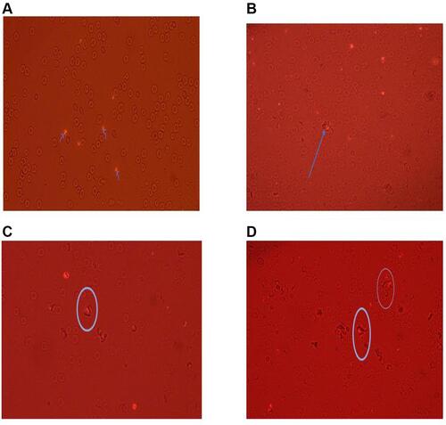 Figure 1 Micrographs of rosetting parasites. (A) infected RBC with parasite showing as bright spots, (B) infected RBC bound by uninfected RBC, (C) small rosette with 2 or 3 uninfected RBC and (D) large rosette with >3 uninfected RBCs.