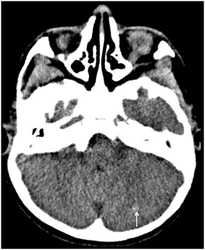 Figure 2. Axial brain computed tomography. Hyperattenuating foci in the left cerebellar hemisphere (white arrow).