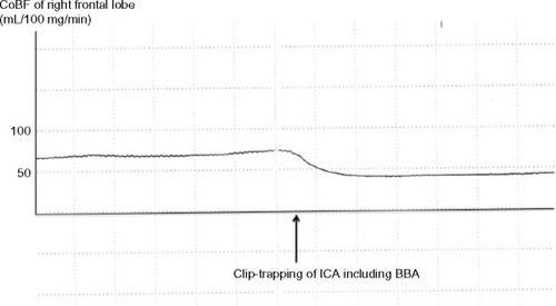 Figure 2 The cortical cerebral blood flow (CoBF) in the frontal lobe decreases immediately after clip-trapping between the area just distal of the origin of the ophthalmic artery and the area just proximal to the origin of the posterior communicating artery, including the ruptured blood blister-like aneurysm (BBA), in the internal carotid artery (ICA). CoBF after clip-trapping decreases by 56% in the right frontal lobe and returns to pre-clamping levels immediately after de-clamping of the ICA.