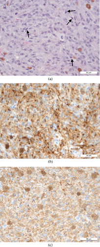 Figure 4. Histology of the nasal mass in case 2: (a) H&E section (×40) demonstrating poor cellular differentiation, which in rare places tended towards spindle cell morphology (black arrows); (b) positive immunohistochemical labelling for Melan-A (×40); (c) positive immunohistochemical labelling for vimentin (×40).