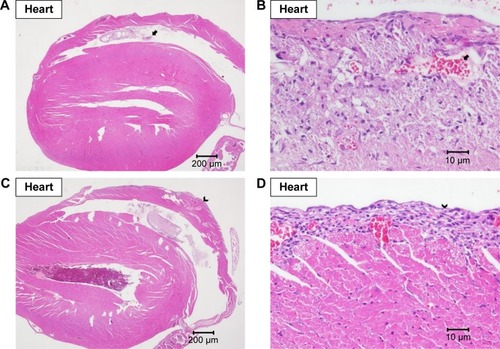 Figure 5 Histopathological analysis of heart.Note: Histopathological analysis with H&E staining of heart at (A) 20× and (B) 400× magnifications with focal fibrotic emboli (arrow), at (C) 20× and (D) 400× magnifications with focal fibrosis (arrow head), and at (E) 20× and (F) 400× magnifications with epicardial mineral deposition (triangle).