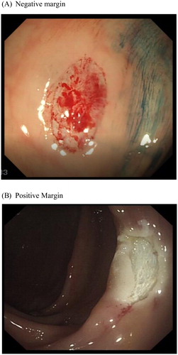 Figure 1. (A) Negative and (B) Positive post snare polypectomy margin and base as viewed with standard white light.