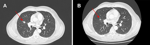 Figure 3 (A) Red arrows show lung metastases at baseline and (B) after 10 cycles of therapy with ribociclib.