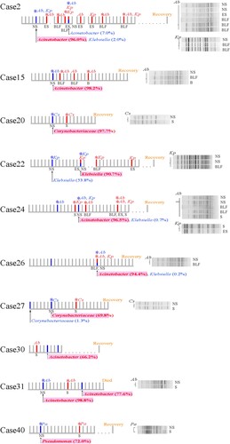 Figure 4. Timeline of cases where the isolated pathobiontic bacterial species belonged to the nasopharyngeal microbiota SDPG. Segments with a solid line represent one day during the disease course; segments with a dotted line represent 5 days during the disease course. Where possible, the PFGE patterns of strains isolated from a given patient are shown to the right of the timeline. SDPG are indicated below each timeline, in text highlighted in light red. Red vertical line indicates the day of clinical strain isolation; blue vertical line indicates the day of nasopharyngeal swab collection; red asterisk indicates the clinical strain analysed by PFGE; blue asterisk indicates the strain isolated from a nasopharyngeal swab and analysed by PFGE. Ab, Acinetobacter baumannii; Kp, Klebsiella pneumoniae; Pa, Pseudomonas aeruginosa; Cs, Corynebacterium striatum; NS, nasopharyngeal swab; ES, endotracheal aspirates; BLF, bronchoalveolar lavage fluid, S, sputum; B, blood.