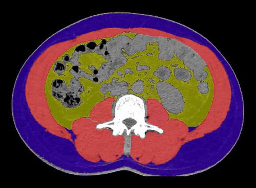 Figure 1 Axial computed tomography images at the third lumbar vertebra region. Skeletal muscle highlighted in red areas, which are evaluated and quantified using thresholds of −29 to +150 Hounsfield units (HU); visceral adipose highlighted in yellow areas, which are evaluated and quantified using thresholds of −150 to −50 HU; subcutaneous adipose highlighted in blue areas, which are evaluated and quantified using thresholds of −190 to −30 HU.