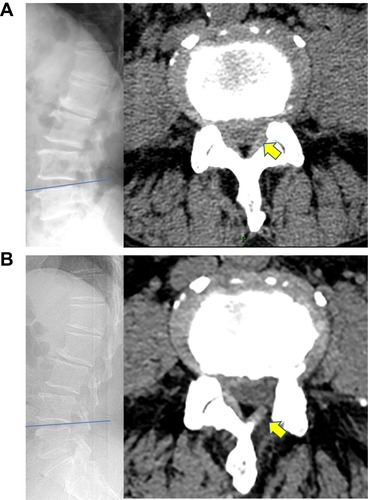 Figure 5 A 76-year-old male patient with lumbar lateral recess stenosis (LRS) who received fenestration. (A) Preoperative computed tomography (CT) images showing severe lateral recess stenosis with LRS at the left L4-5 level (yellow arrowhead). (B) Postoperative CT images showing a thorough nerve decompression (yellow arrowhead).