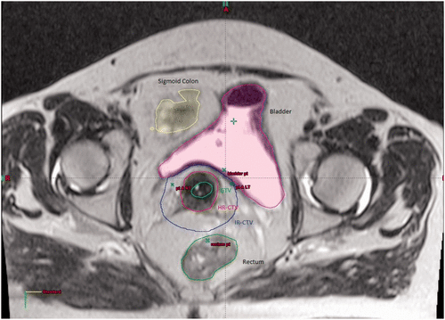 Figure 1. The image shows an axial slice from a T2 weighted MRI-guided adaptive brachytherapy planning scan. Delineated on the scan are the GTV (green), HR-CTV (red), IR-CTV (blue) and OAR (sigmoid colon (yellow), bladder (purple) and rectum (green)).