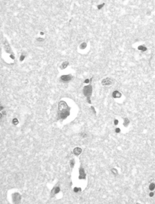 Fig. 3 Autoptic frontoparietal cortex. PAS-positive diastase-resistant intraneuronal inclusions. PAS/D. Original magnification, × 40.