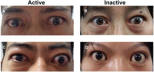 Figure 2 Clinical characteristics of thyroid eye disease. (A) Moderate active TED: lid retraction with evidence of orbital tissue inflammation; (B) Moderate inactive TED: lid retraction; (C) Severe active TED: upper eyelid retraction and binocular soft tissue inflammation; (D) Severe inactive TED: lid retraction with proptosis. Reproduced from Li Q, Ye H, Ding Y, et al. Clinical characteristics of moderate-to-severe thyroid associated ophthalmopathy in 354 Chinese cases. PLoS One. 2017;12(5):e0176064. Creative Commons License and Disclaimer available from: http://creativecommons.org/licenses/by/4.0/legalcode.Citation38