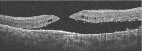 Figure 11 FTMH and a large amount of subretinal fluid. ERM and minimal intraretinal cystic fluid are also present.