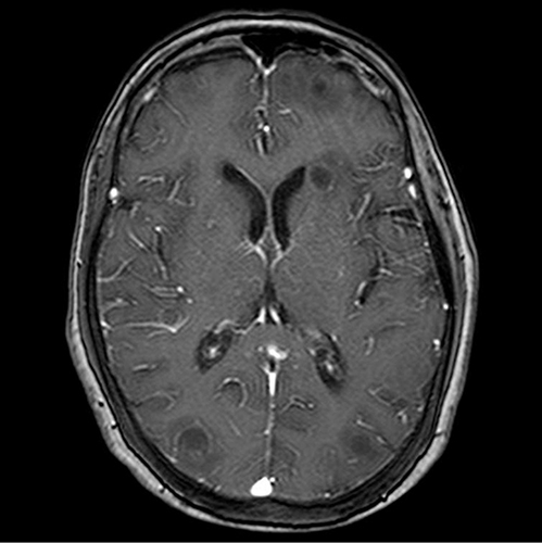 Figure 1 MR findings on May 26: Multiple nodular lesions were observed in the bilateral cerebral, cerebellar, and basal ganglia regions, accompanied by peri-lesion edema and mild ring enhancement.