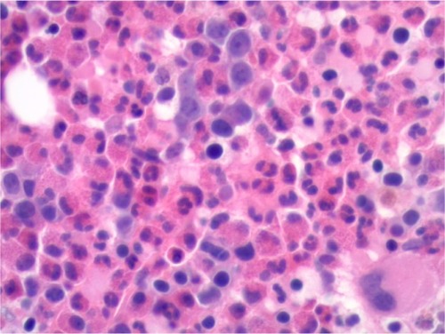 Figure 2 Bone marrow biopsy.