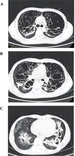 Figure 2 A follow-up chest HRCT scan from August 16, 2022, during the patient’s hospitalization, reveals increased and enlarged lucencies in the upper lobes of both the lungs and more extensive lesions in the lower lobes compared to the images from July 26, 2022. (A) Tracheal bifurcation level: It remained predominant honeycomb with significantly less shaded infiltrated patches, the lobular interval was thinner, (B) The bronchial level of the right middle segment: Like the changes in upper lung, the honeycomb range was expanded, the lobular septum became thinner, and the nodule infiltration was significantly reduced, (C) The bronchial level of the basal segment: The scope of nodular invasion expanded and honeycomb was added.