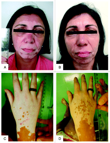 Figure 9. Photographs of two female patients with vitiligo before (A and C) and after (B and D) six months of treatment with vitamin D (35,000 IU per day). (A and B) A 50 y-old patient with BMI of 28.3 achieving between 51 and 75% of repigmentation (quartile 3) after six months of treatment; her serum concentration of 25(OH)D3 was 12.5 ng/mL, at baseline, reaching 92.4 ng/mL after 6 mo of treatment. (C and D) A 36 y-old patient with BMI of 22.7 achieving between 1 and 25% of repigmentation (quartile 1) after six months of treatment; her serum concentration of 25(OH)D3 was 12.0 ng/mL, at baseline, reaching 92.5 ng/mL after 6 mo of treatment.