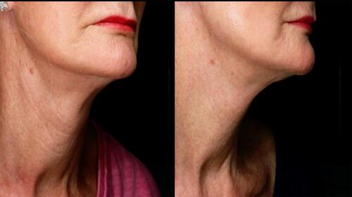 Figure 1 Before and after pictures of a patient treated for skin quality fillers. Treatment description: Neck- Juvederm Volite, 1mL per side, in the most superficial layer of skin using a needle. (contributed by Catherine Ellen Porter).