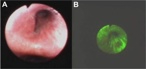 Figure 3 High grade dysplasia in lung tissue in white light bronchoscopy (A) and autofluorescence (B) imaging.