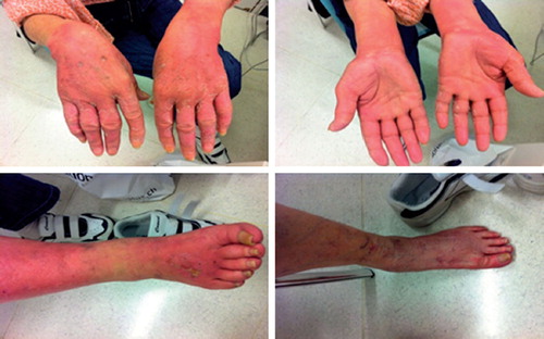 Figure 1. Erythema, desquamation and swelling over the hands after the second cycle of docetaxel. Rash in the dorsal surfaces of hands and feet