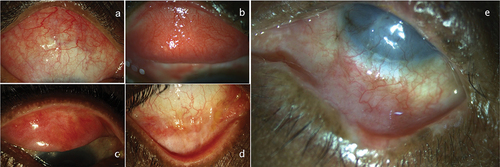 Figure 3. The conjunctival changes showing chemosis and follicular reaction in the bulbar conjunctiva (a), a lacy follicular reaction in the tarsal conjunctiva (b), subconjunctival fibrosis of the palpebral conjunctiva (c), forniceal shortening (d), and symblepharon formation (e).
